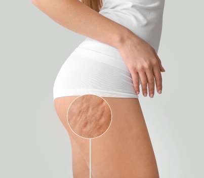 Cellulite Treatment